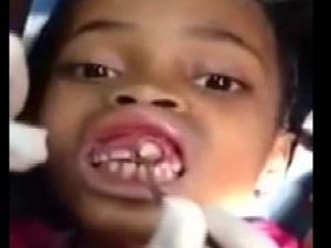 Küçük kızın diş etinden çıkanlara inanamayacaksınız