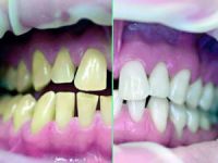 Diş beyazlatıcı ürünlere dikkat!